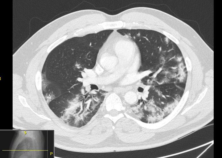 CT scan of the chest 4 days before the initiation of ECMO