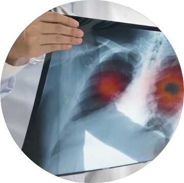 Lung cancer scans