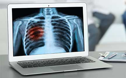 Lung cancer imaging on a laptop