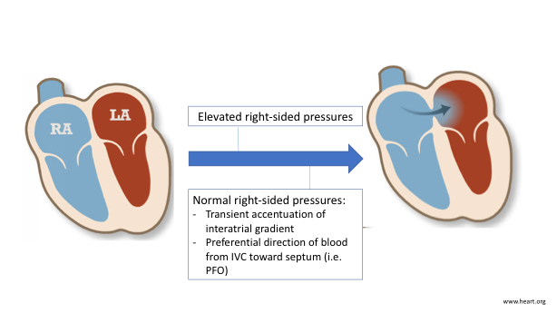 Patent Foramen Ovale: A Cause for Refractory Hypoxemia - American ...