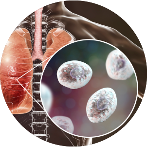 Pneumocystis jirovecii or carinii in human lungs, opportunistic fungus that causes pneumonia in patients