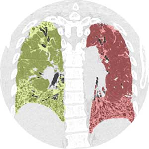 The lung areas on HRCT imaging are identified