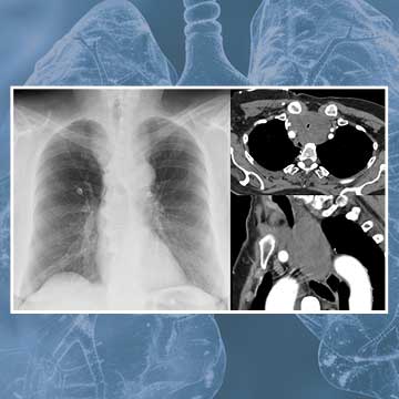 Central airway obstruction guideline imagery