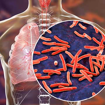 Secondary tuberculosis in lungs and close-up view of mycobacterium tuberculosis bacteria.