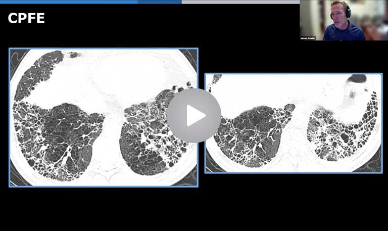 CT in Fibrotic ILD – Part 2