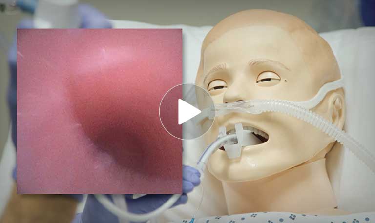 Difficult Airway: Awake Intubation