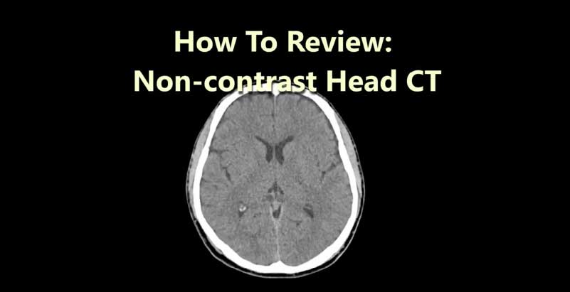 Screening for Potentially Life-Threatening Pathology on Non-contrast Head CT for the Intensivist – Part 2