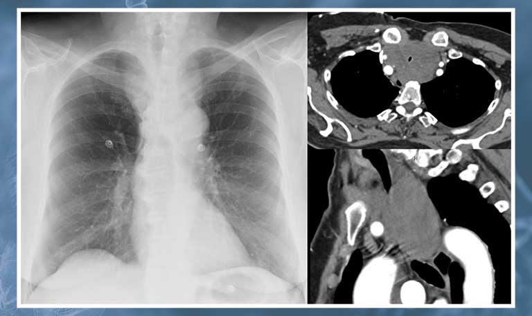 Central airway obstruction guideline imagery